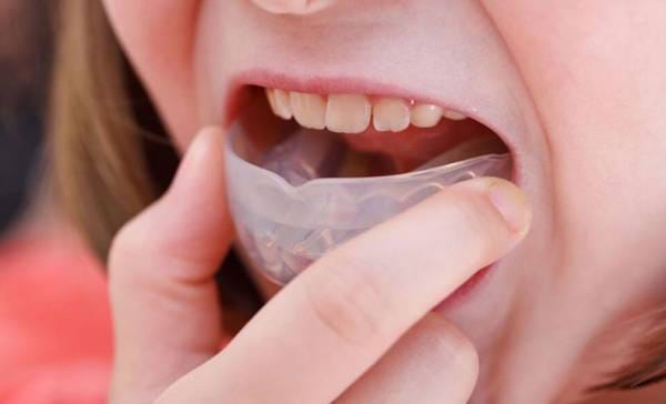 ما هو الحارس الليلي للأسنان وما فوائده؟ + أنواع | by akoo | Medium