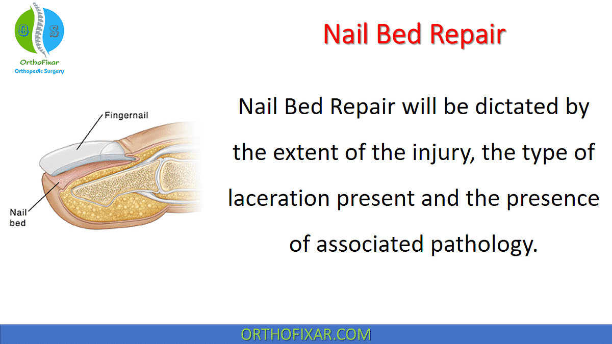 Nail Bed Repair by Orthofixar Orthopedic Medium