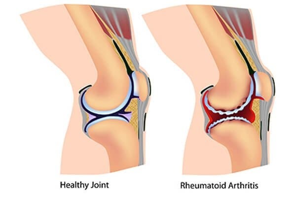 Exploring Alternatives to Knee Replacement Surgery