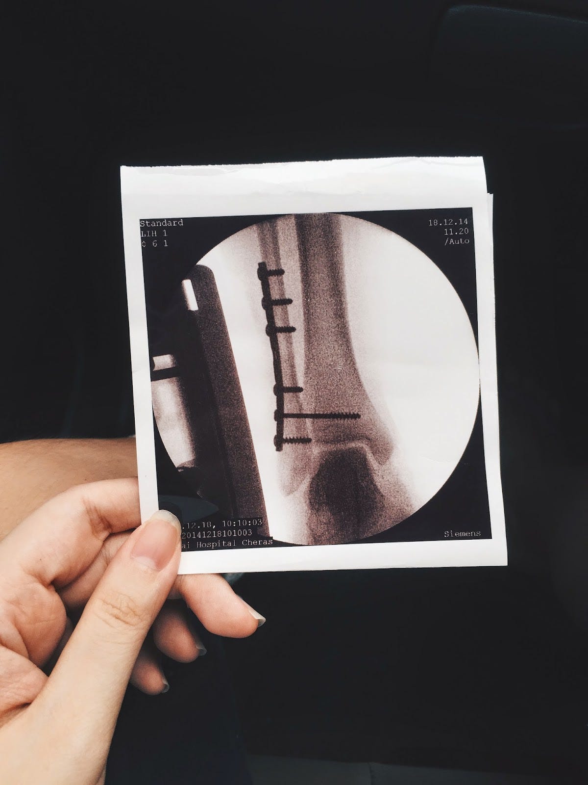 Week 14 of bed rest and boredom — Broken Ankle Pt. 1 by Carmen C