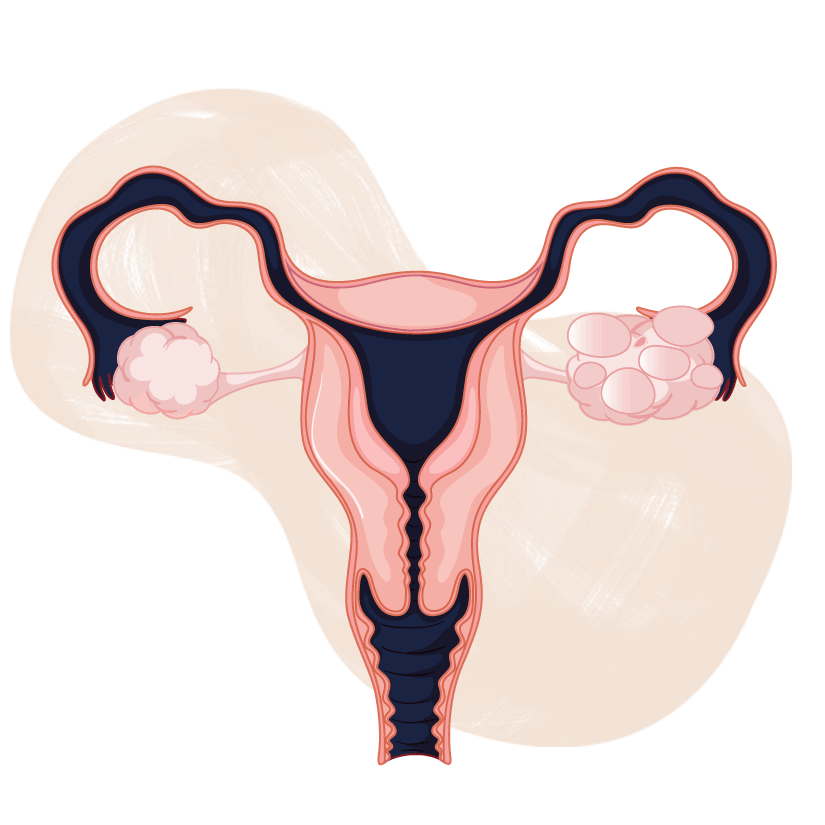 pcos-and-pregnancy-https-www-somanicardiacgynecologycentr-by