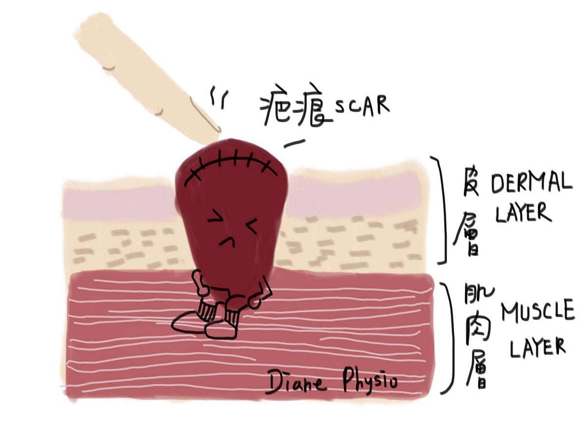 Scar adhesion, why and how.. Adhesion is like a nightmare to… by 杜婉瑜