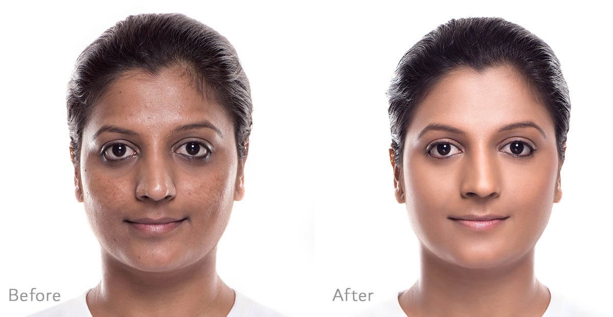 Hyperpigmentation & DeTanning Treatment — Cheryl’s Cosmeceuticals by