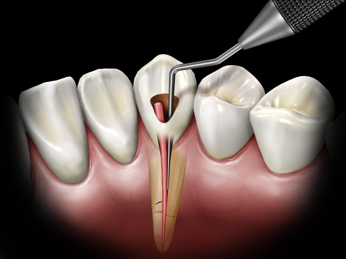 How Do I Know If I Need a Root Canal?