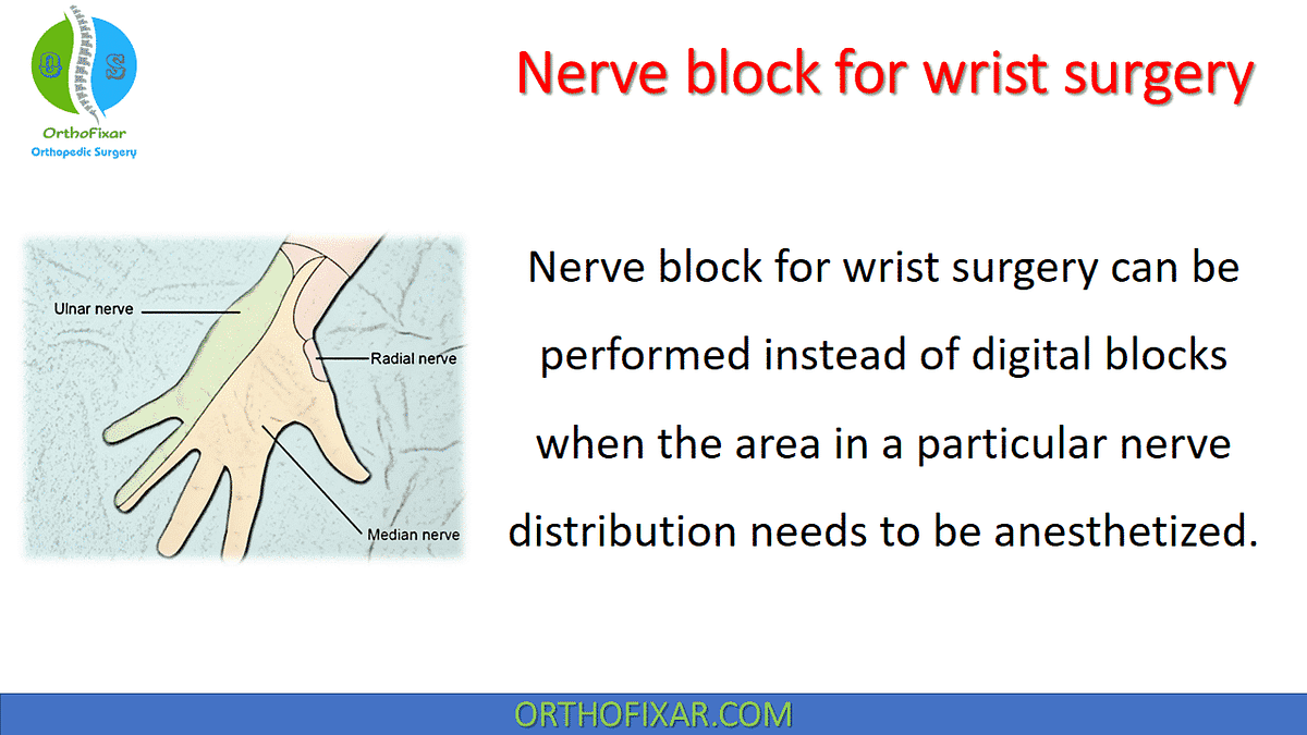 Nerve block for wrist surgery by Orthofixar Orthopedic Medium