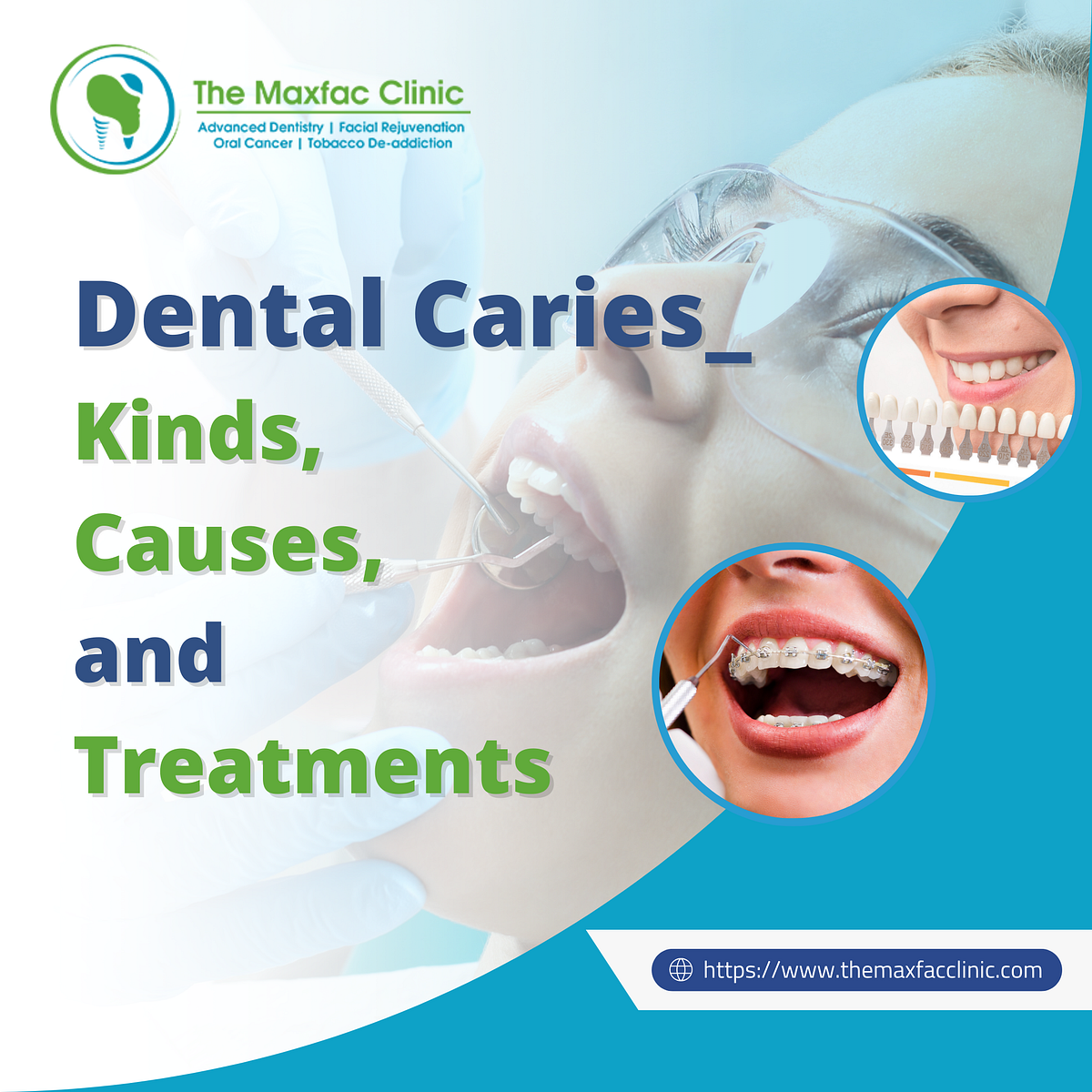 Dental Caries Kinds Causes And Treatments By MaxFac Clinic Medium