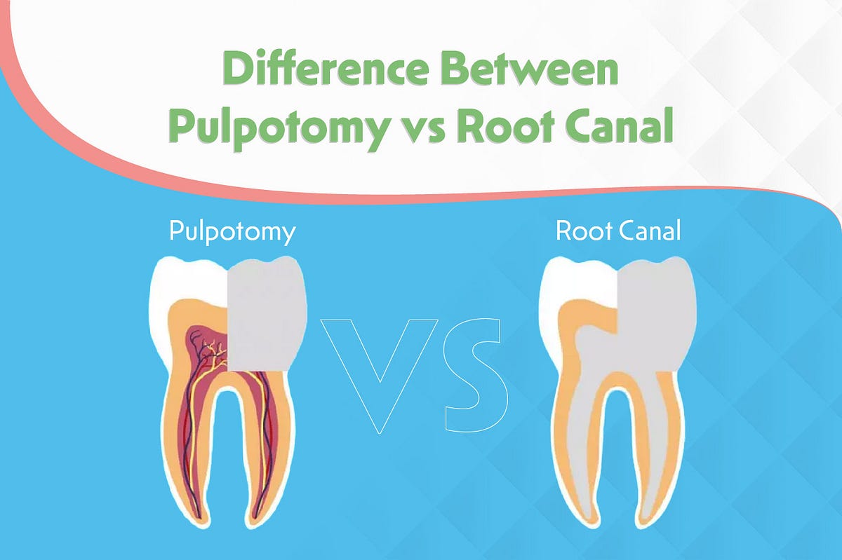 What is the Difference Between Pulpotomy vs Root Canal by