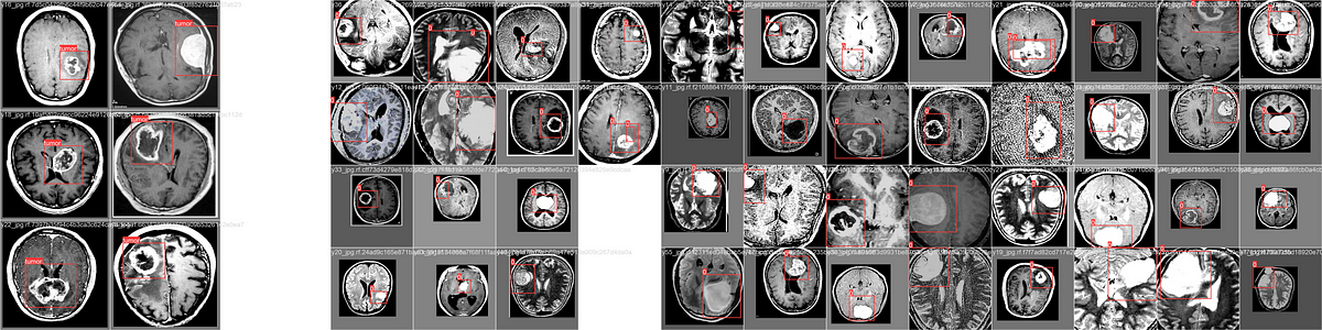 Brain-tumor Detection YOLOV8 vs SAM 2. | by Pascal Musa | Medium