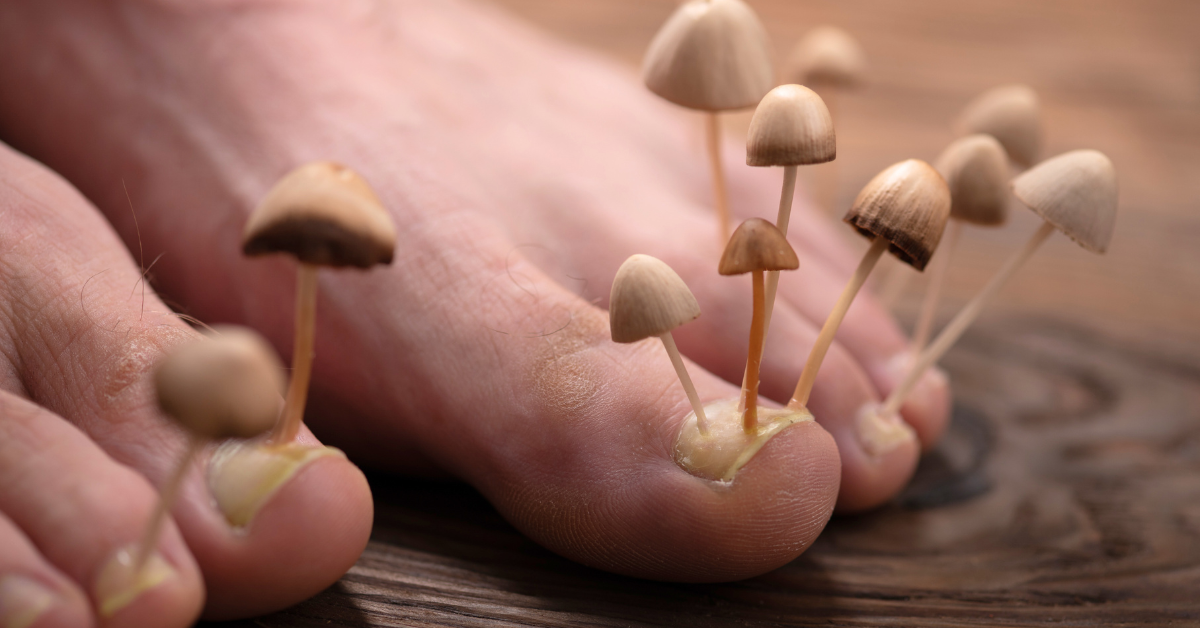 How To Get Rid of Green Nail Fungus? Medium