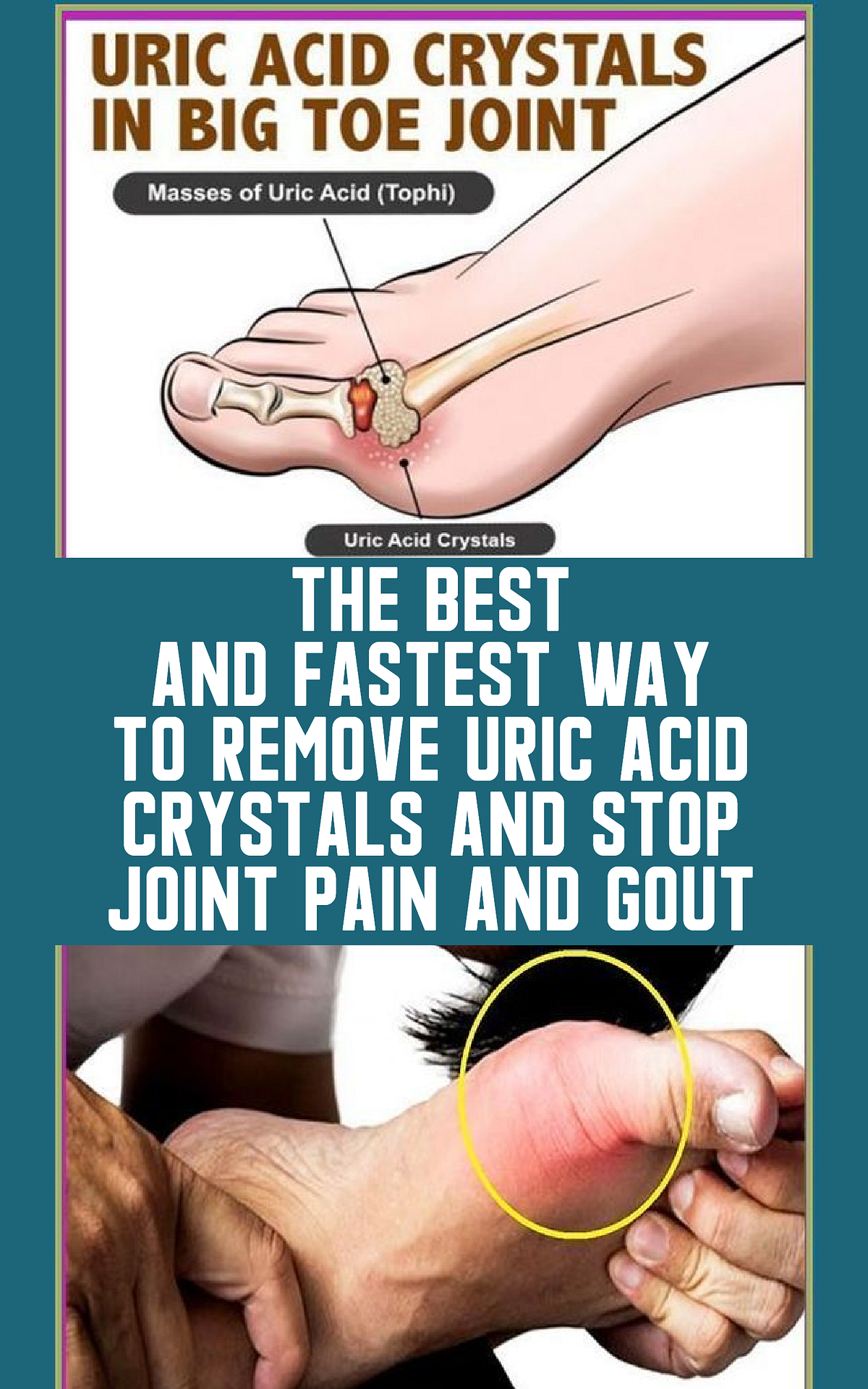 THE BEST AND FASTEST WAY TO REMOVE URIC ACID CRYSTALS AND STOP JOINT