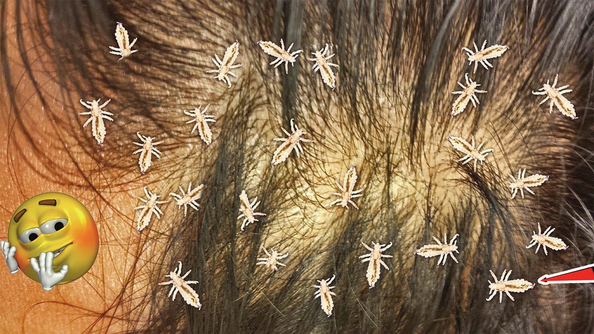 Millions Lice Picking Big Lice From Head Vath HOURN Medium