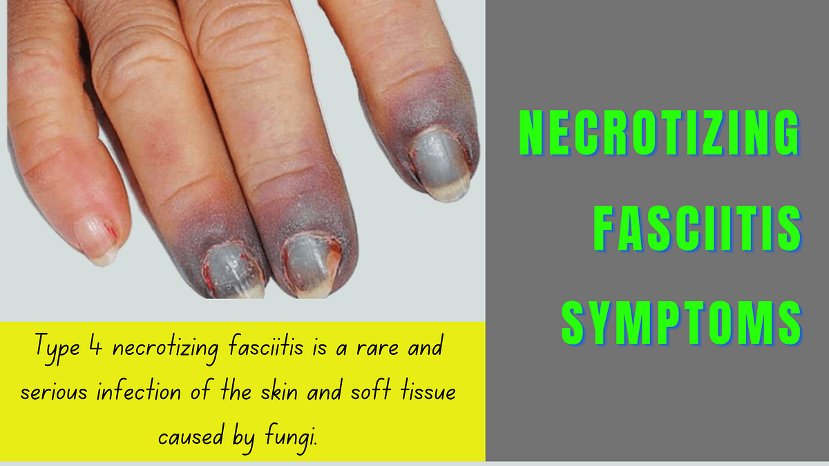 Necrotizing fasciitis symptoms. What is type 4 necrotizing fasciitis ...