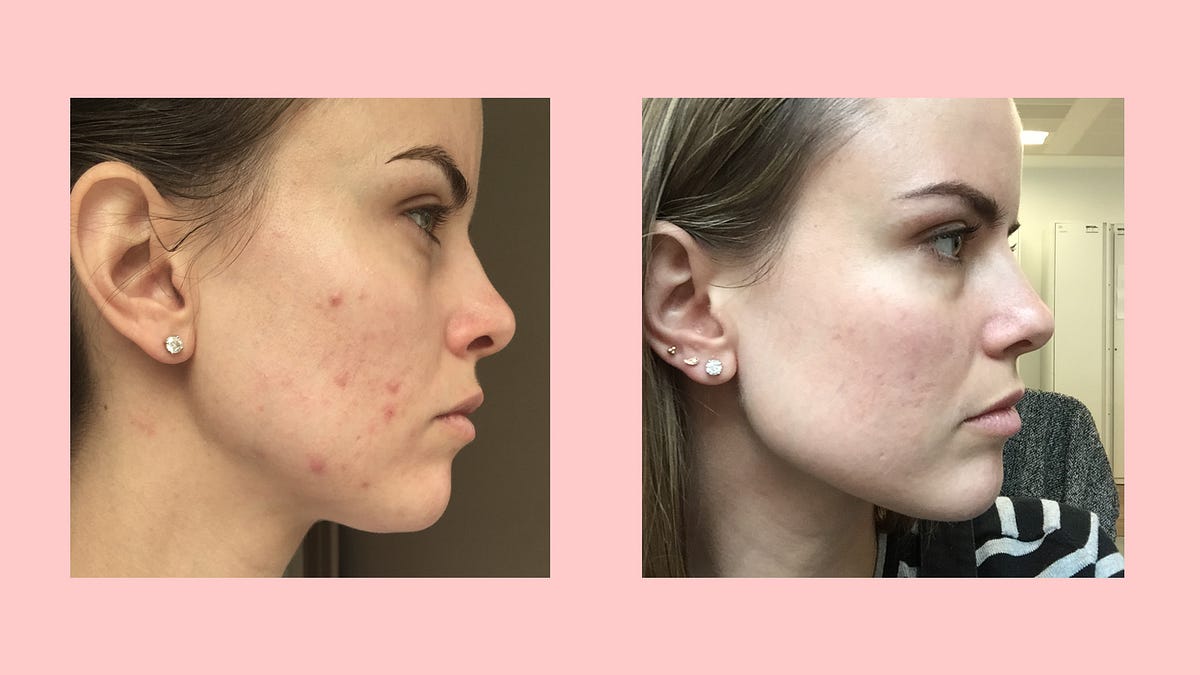 Acne Dairy Products. Acne Diet Rule 4 — Avoid All Dairy… by Vikas