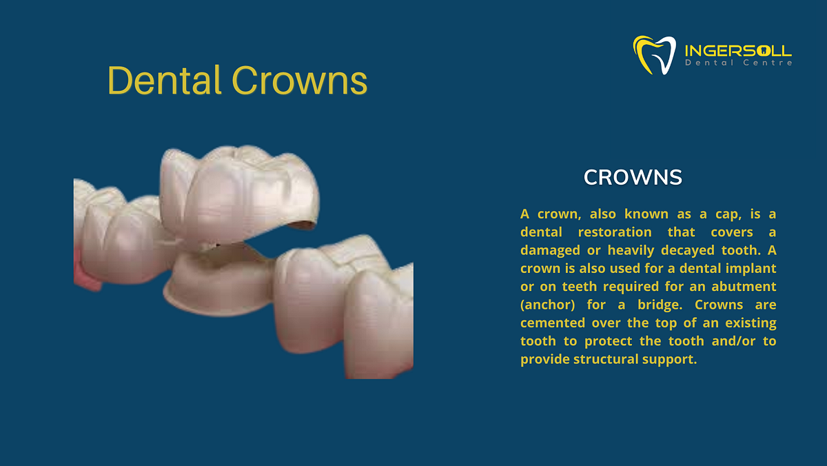 What are the Benefits and Drawbacks of Dental Crowns? by INGERSOLL
