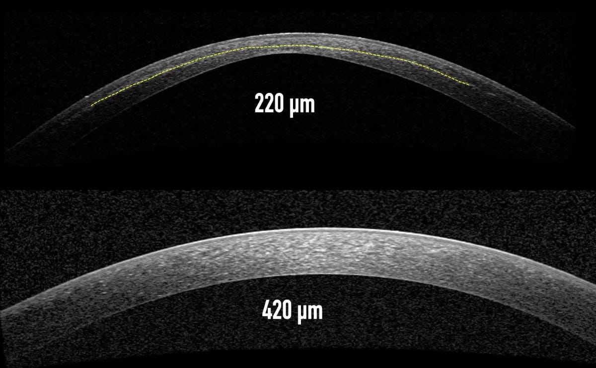 Choosing the Right Refractive Surgery