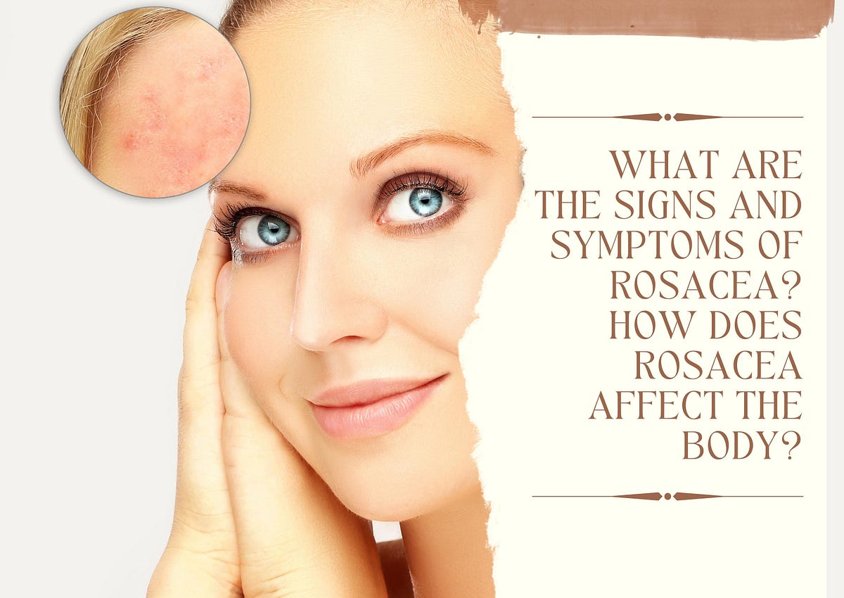 What are the signs and symptoms of Rosacea? How does Rosacea affect the