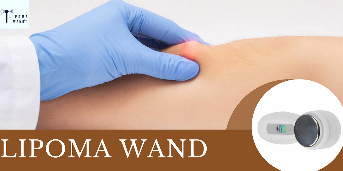 Exploring the Latest Breakthroughs in New Lipoma Treatment by Lipoma