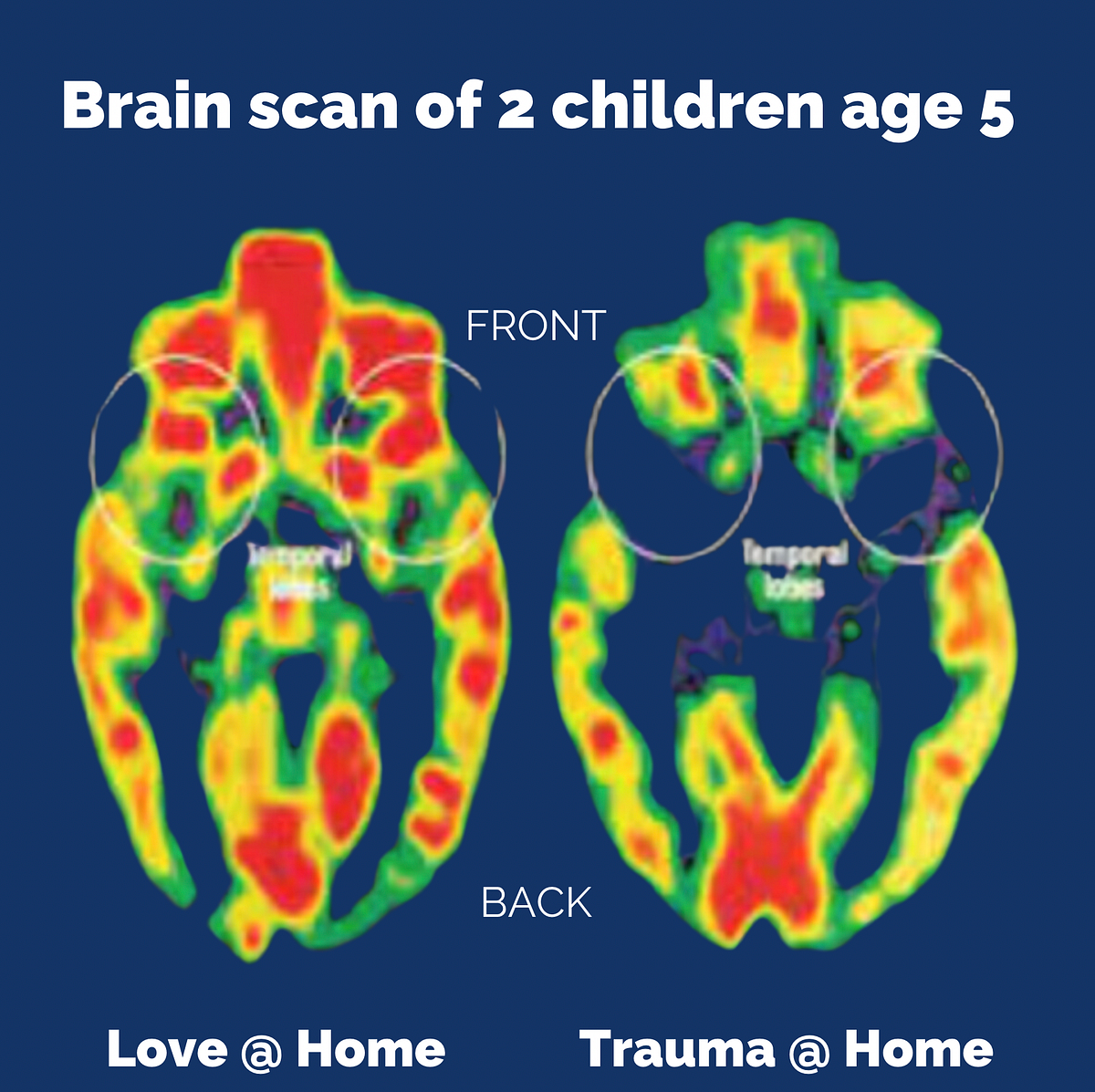 How Childhood Trauma effects the brain in business. by Shannon
