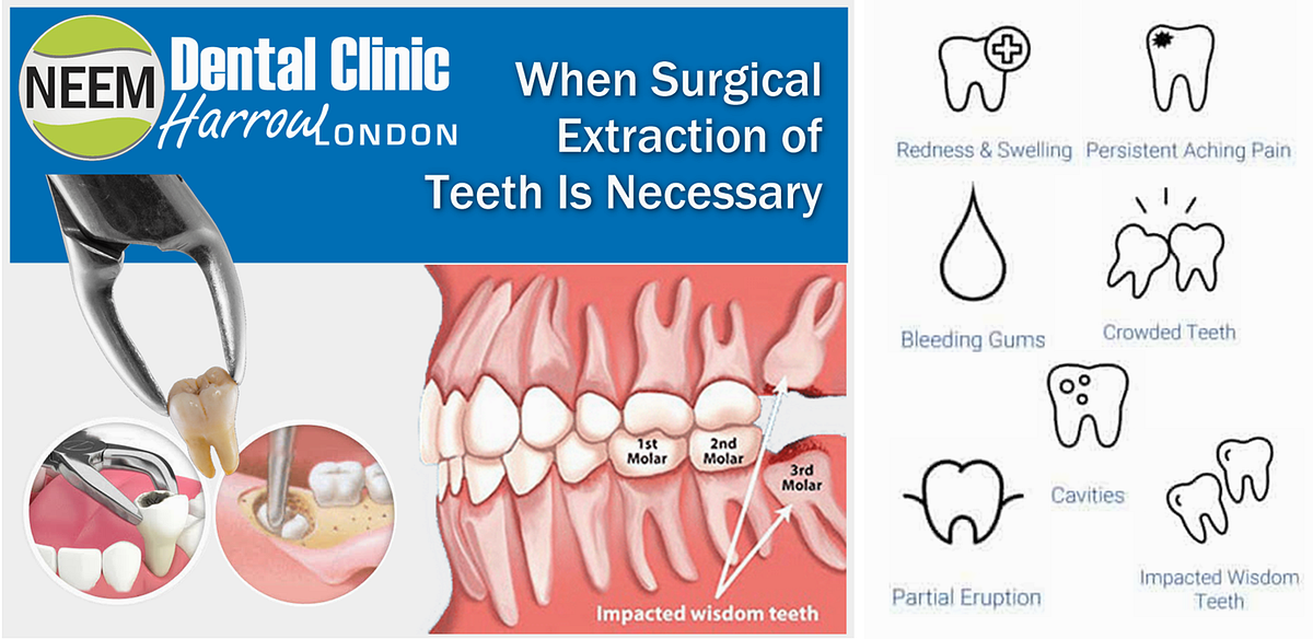 You can book an appointment for a tooth extraction Renny Rohit Medium