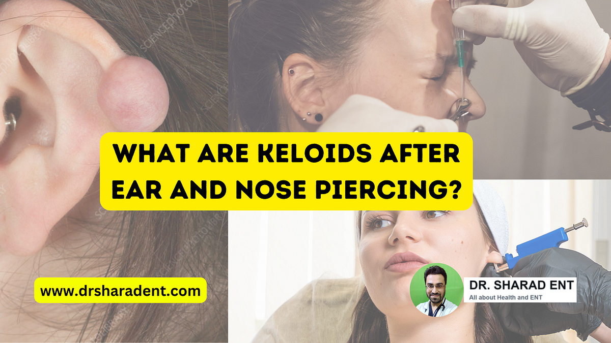 What are Keloids that develop after Ear and Nose Piercing? by Dr