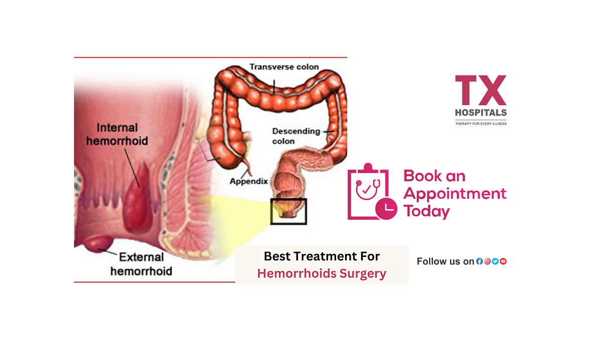Relief and Recovery Exploring Hemorrhoid Surgery by TX Hospitals
