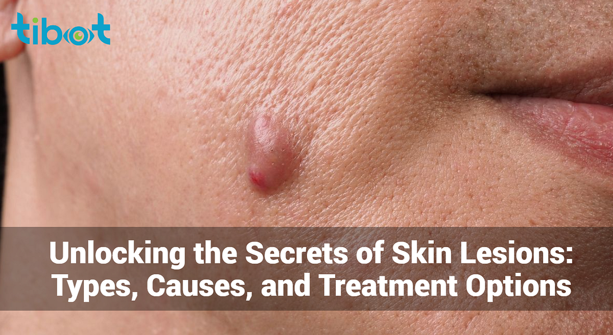 Unveiling the Enigma of Skin Lesions: Types, Causes, and Treatment 