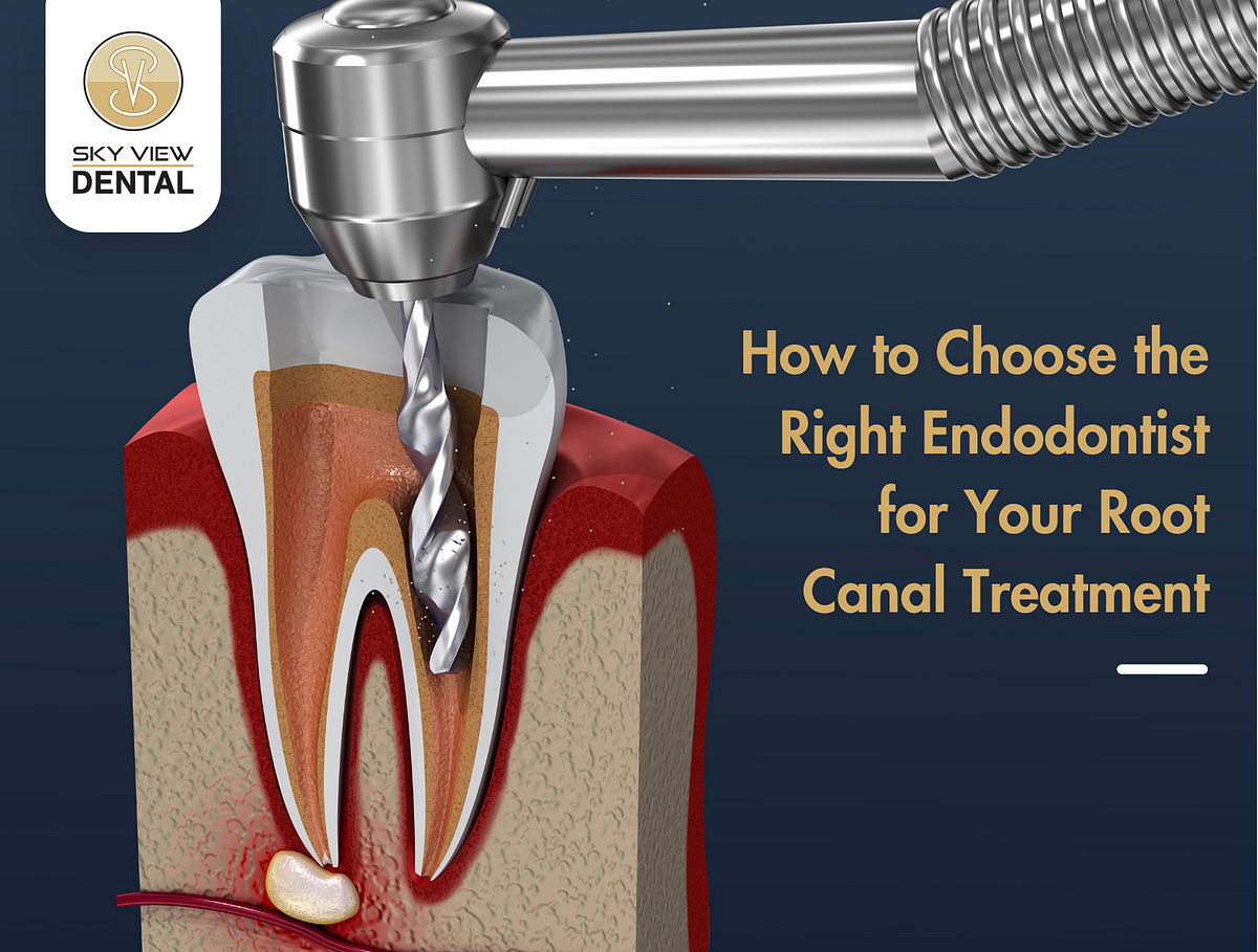 How To Choose the Right Endodontist for Your Root Canal Treatment by