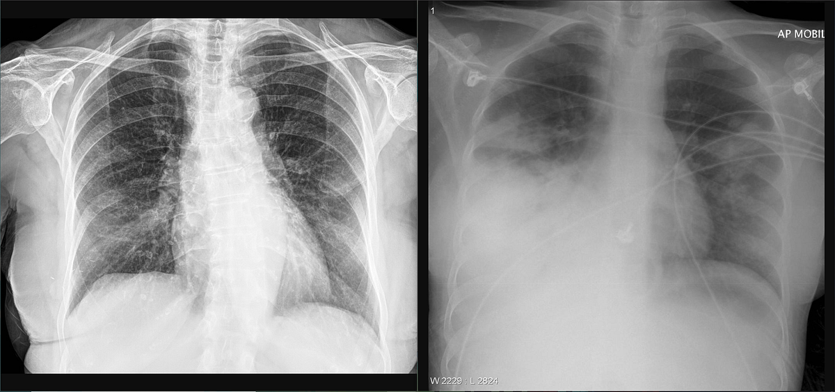 Using Deep Learning to detect Pneumonia caused by NCOV19 from XRay