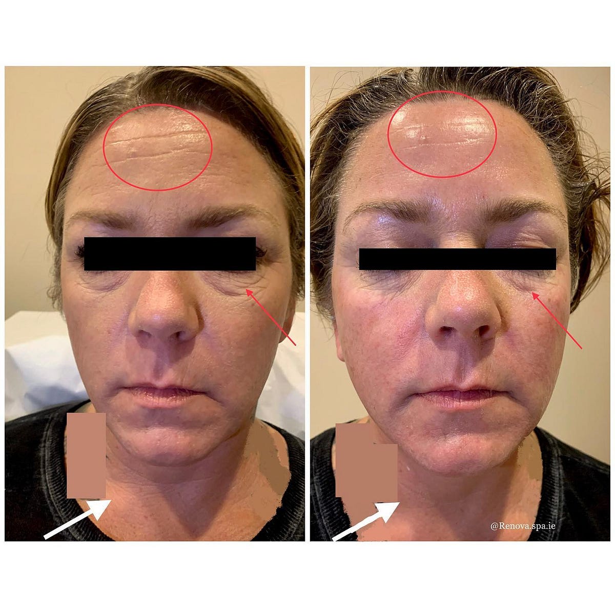 Turn back the clock with HIFU Renova Spa Temecula Medium