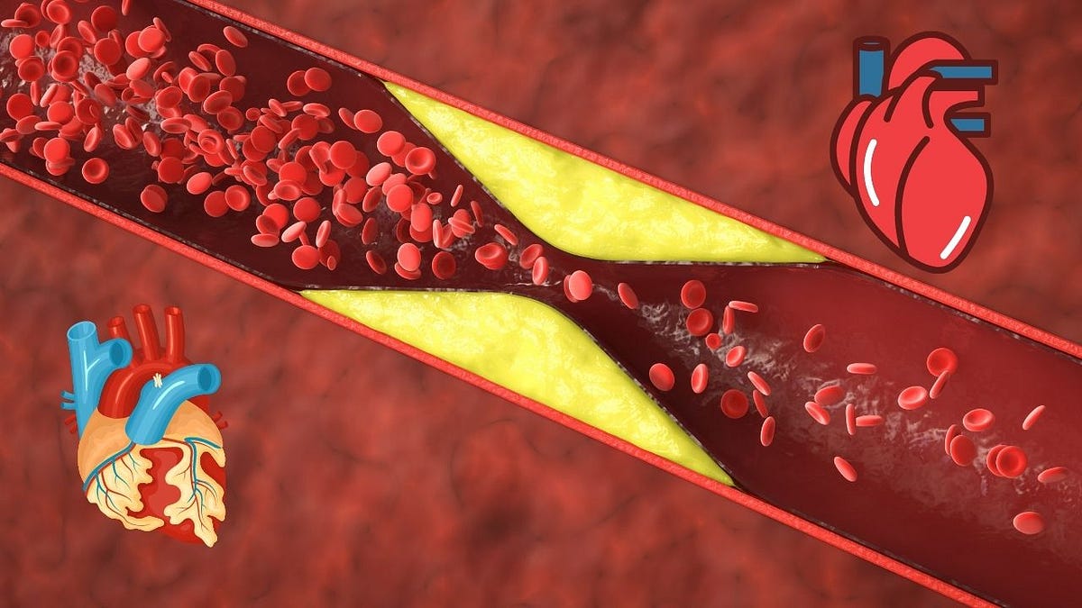 Is it possible to remove the plaque from arteries? News Ki Baat Medium