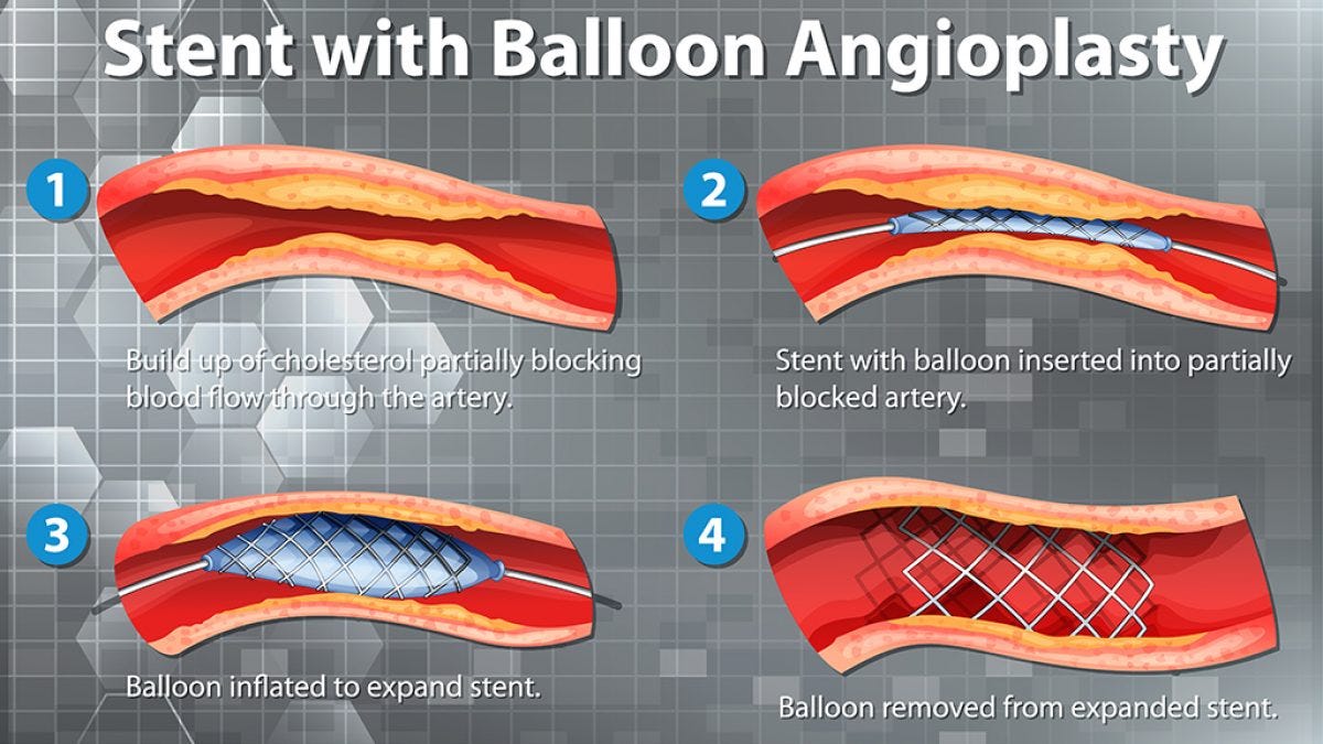 Understanding Angioplasty A StepbyStep Journey from Blockage to