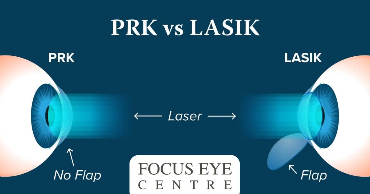 PRK vs LASIK: Which Eye Surgery Is Right for You?
