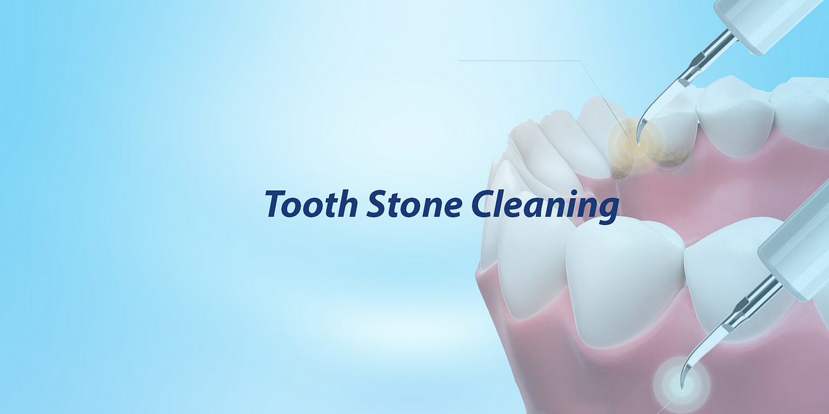 WHAT IS TOOTH STONE, HOW IS IT FORMED? by Kayşehir dental clinic Medium