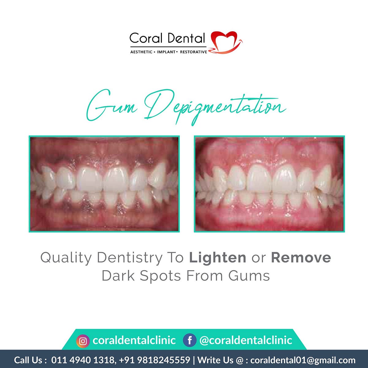 Gum Bleeding and Its Cause. Do your gums drain effectively? It may