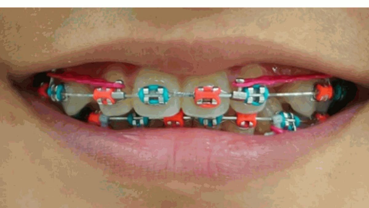 Power Chains Braces Comprehensive Guide to a Perfect Smile Abandor