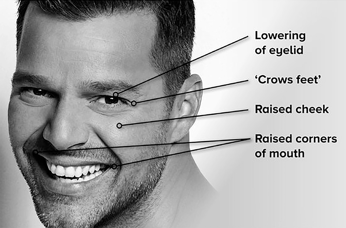 Smiles Without Endorphins. Smile Without Orbicularis Oculi Muscles