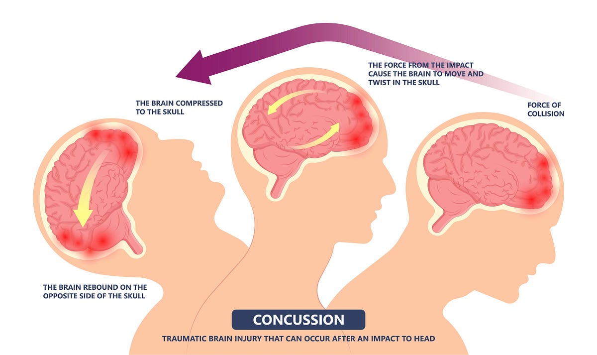 Exploring the Connection Between Concussions and Neck Pain | by Dr ...