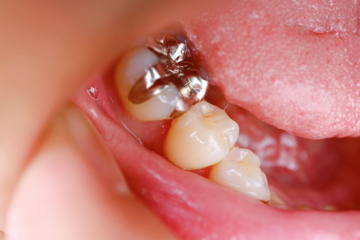 Preserving Baby Teeth The Strength Of Silver Teeth Crowns Dental preserving-baby-teeth-the-strength-of-silver-teeth-crowns-dental