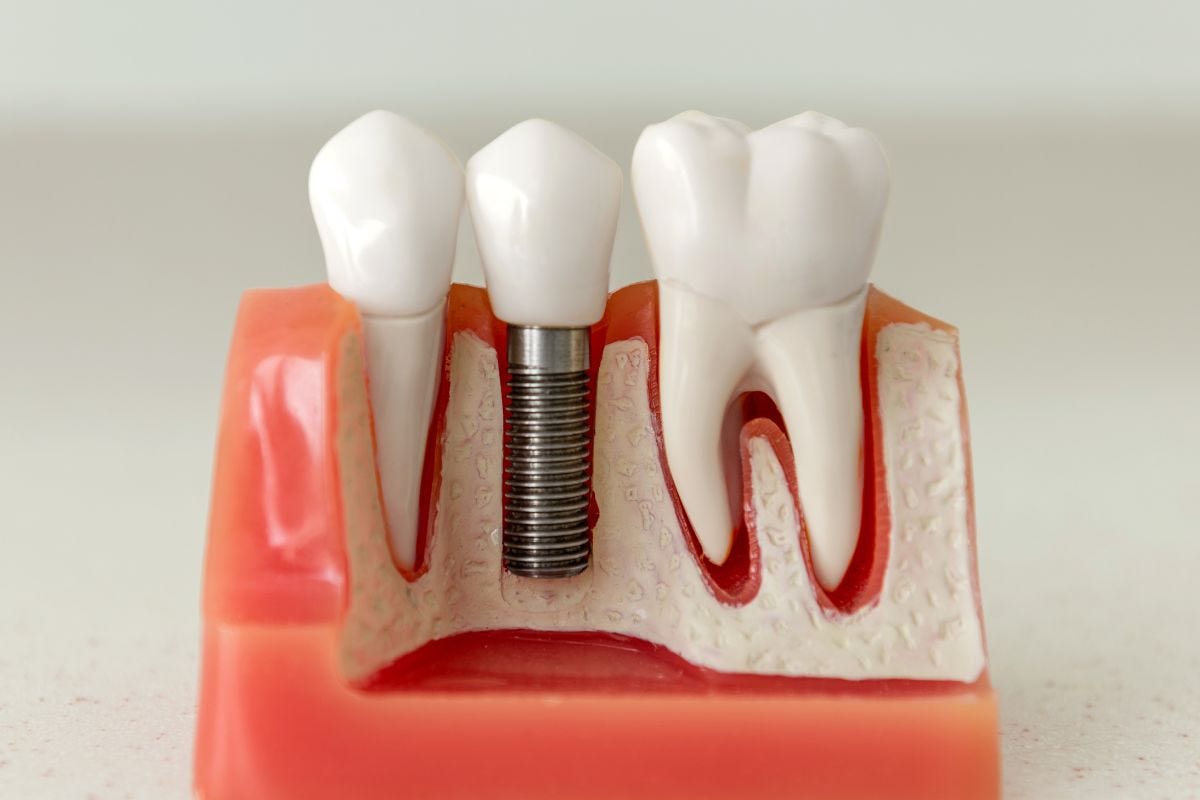 How Dental Implants Can Restore Your Enjoyment of Food by Biltmore