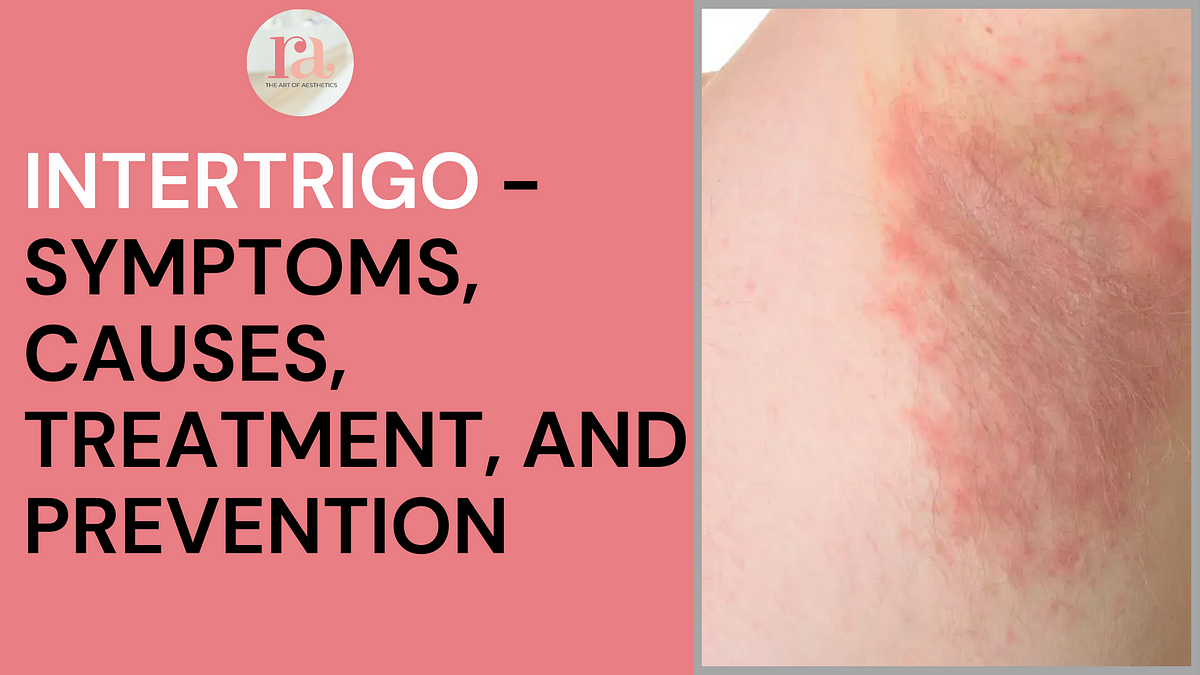 What Are Intertrigo Symptoms And Causes Rakshaaclinic Medium