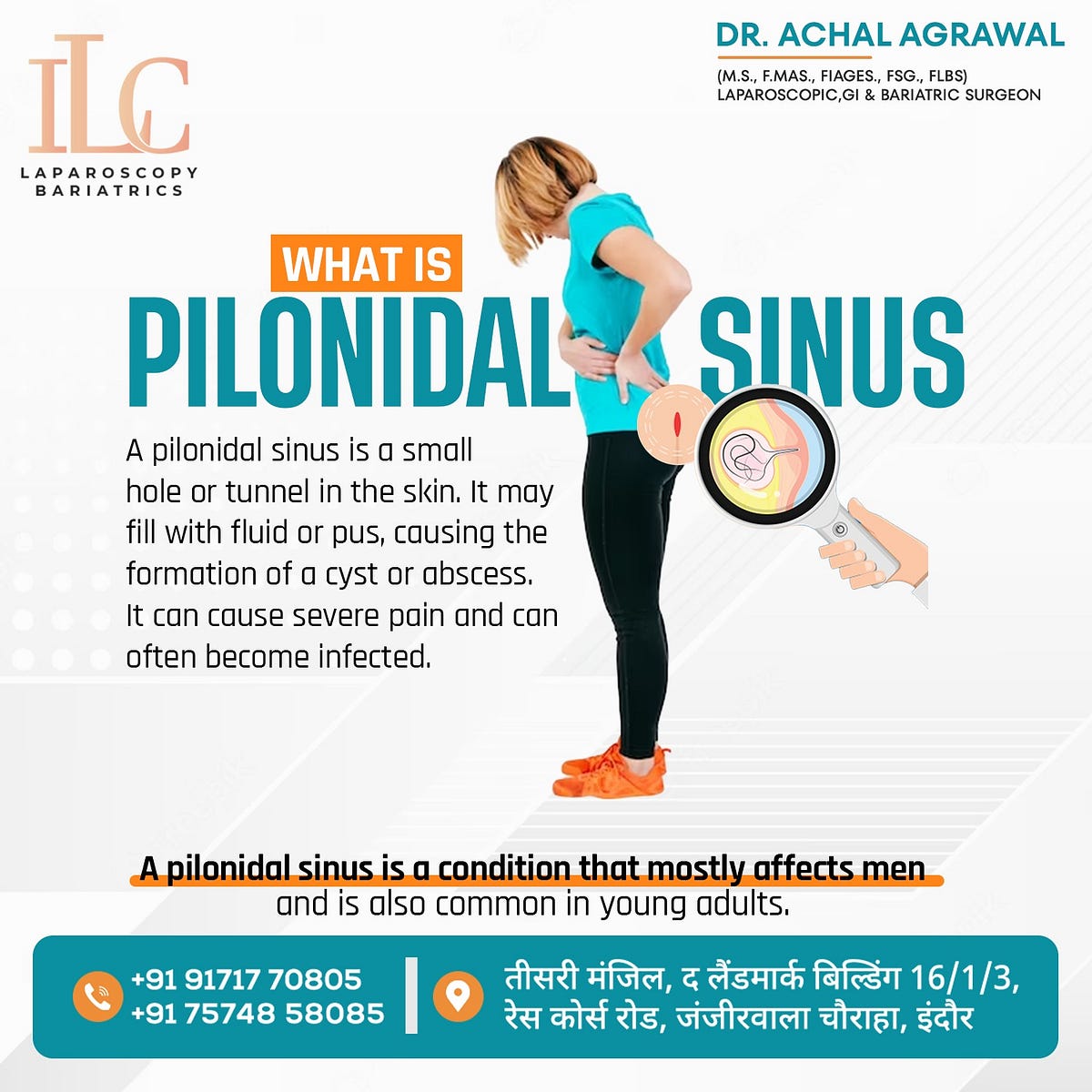 Pilonidal sinus treatment in Indore — Dr. Achal Agrawal Proctologist