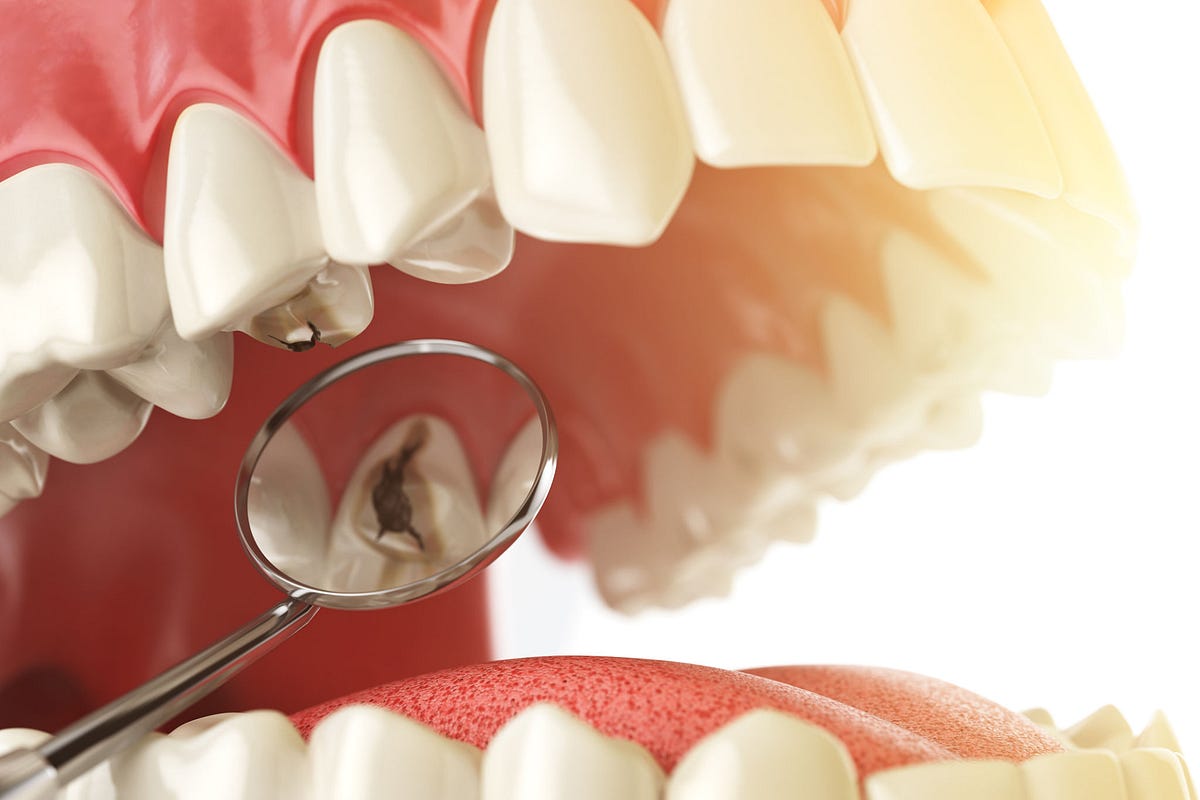 The Importance of Oral Hygiene in Preventing Tooth Decay by LifeCare