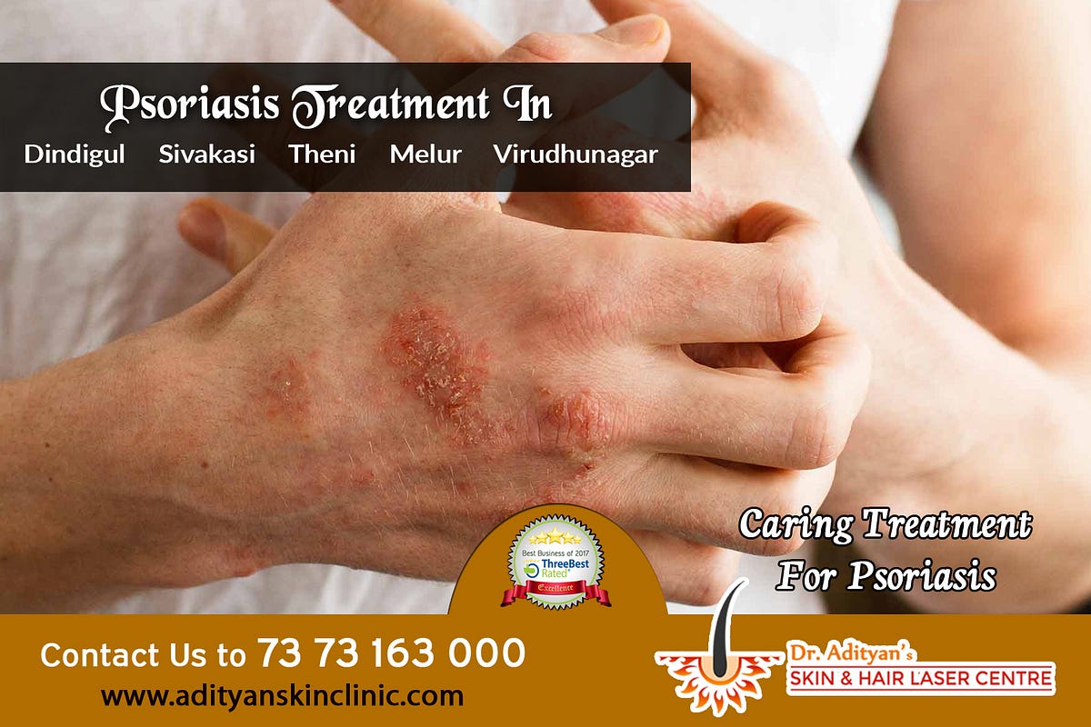 How Can Psoriasis Flareups Can be Prevented? by manjuwarrier Medium