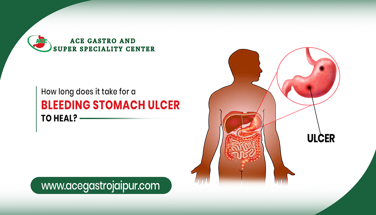 How long does it take for a bleeding stomach ulcer to heal? by Dr