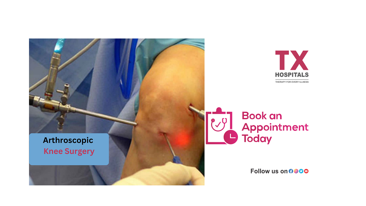 Arthroscopic Knee Surgery What to Expect and How to Prepare by TX