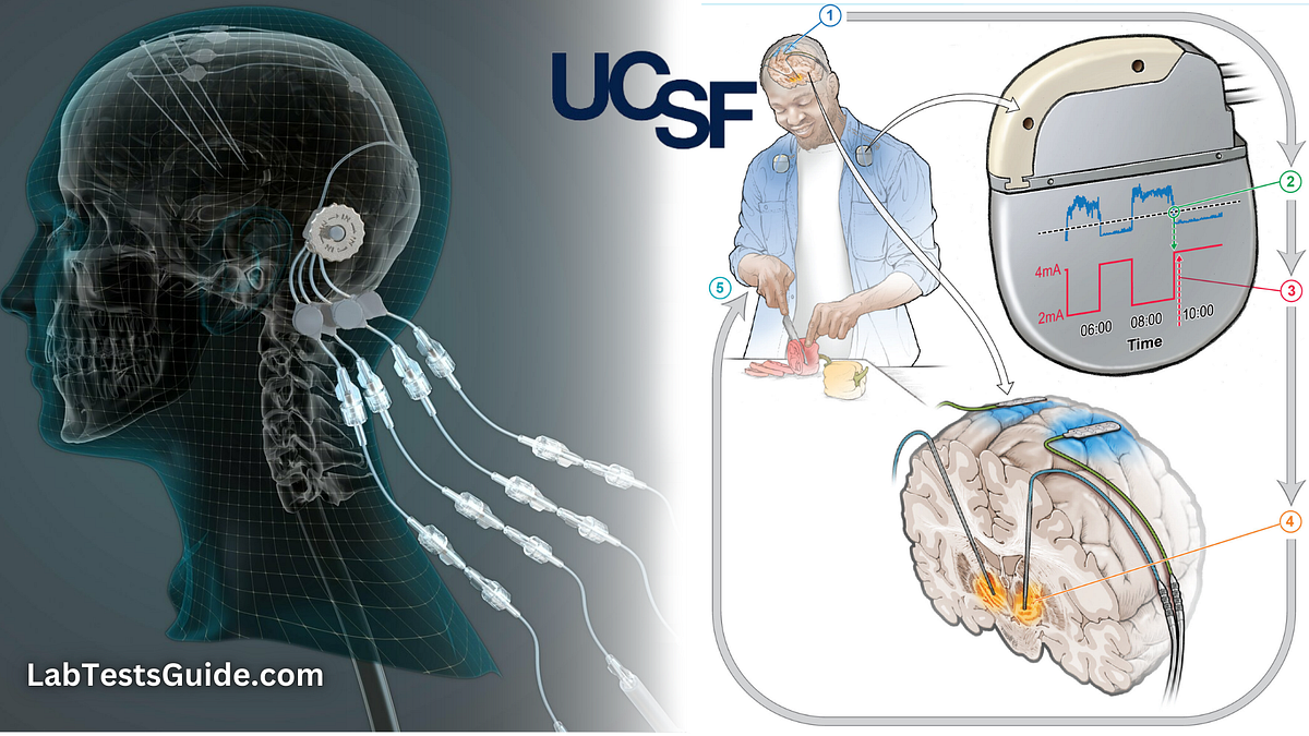 Taming Parkinson’s Disease with Intelligent Brain Pacemakers | by Lab ...