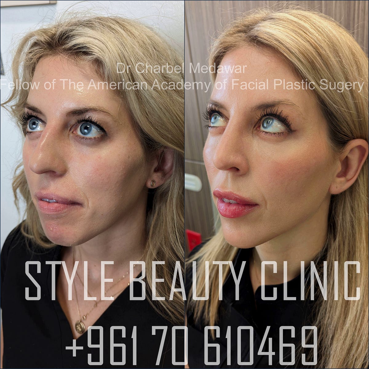 Dr Charbel Medawar’s Secret to Achieve True Beauty - Dr Charbel Medawar