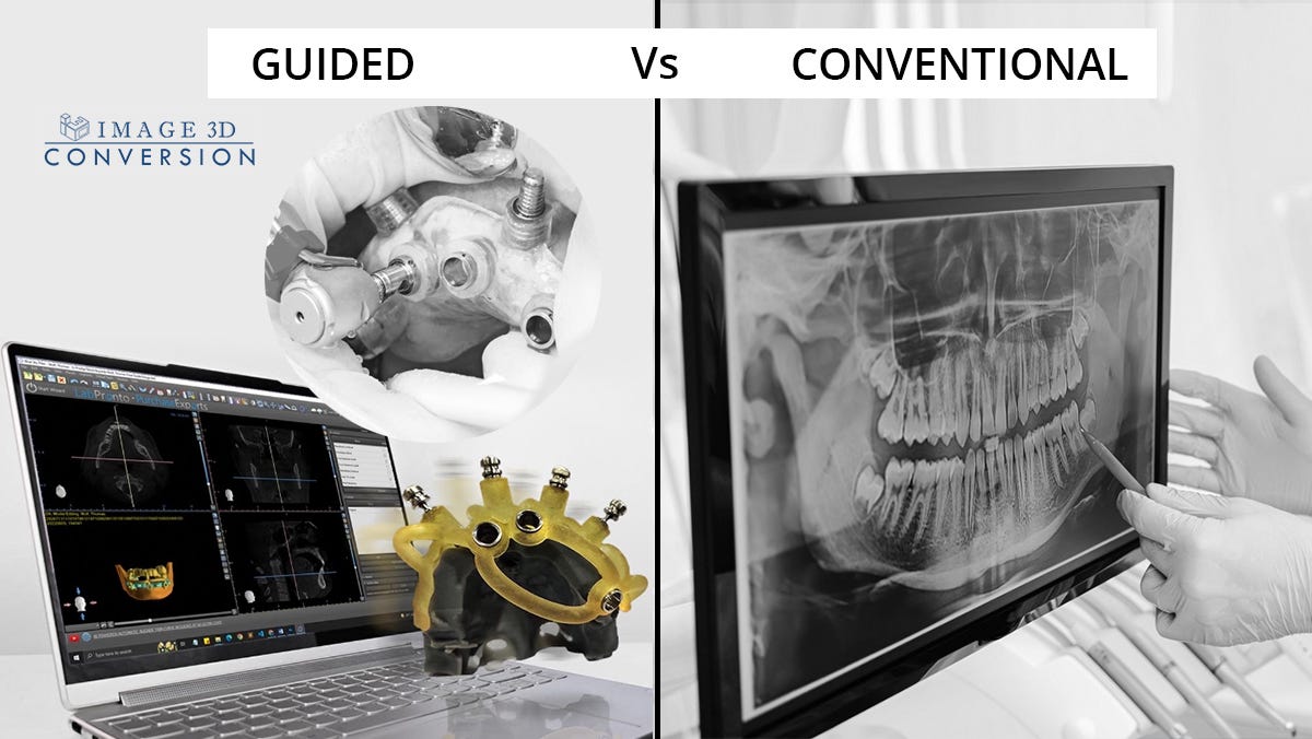 Guided vs Conventional Dental Implant Surgeries