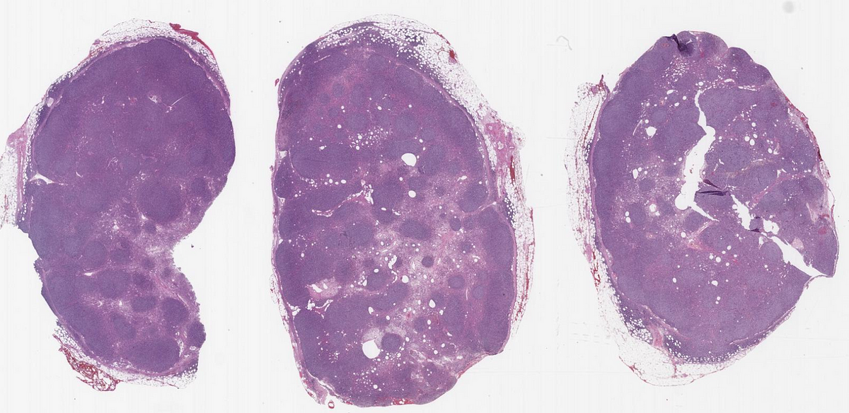 Follicular Large B-Cell Lymphoma. Lessons From The Friday Unknowns | By ...