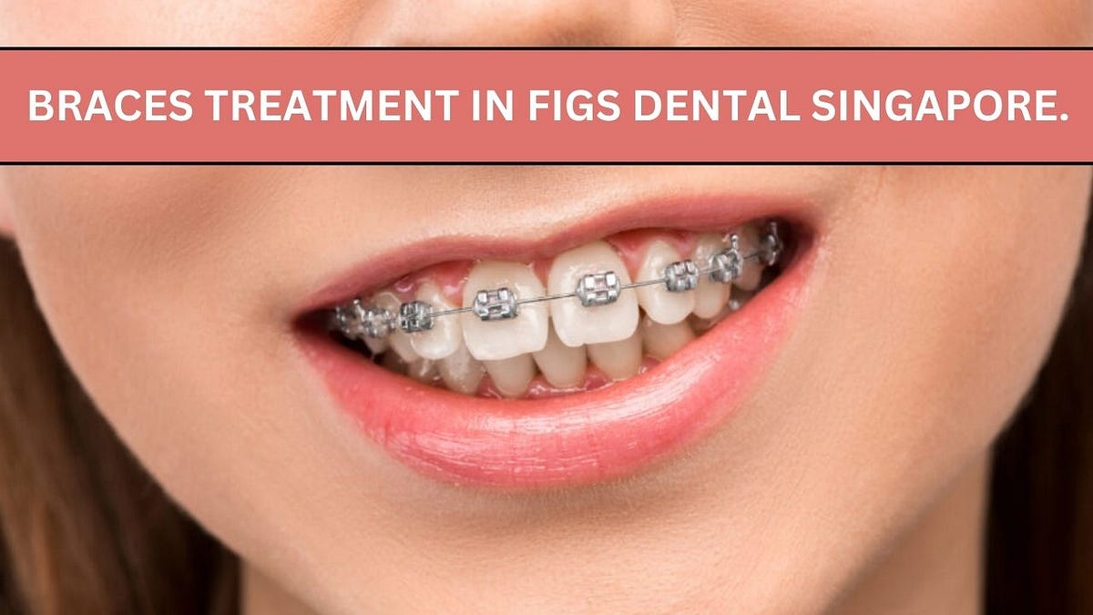 Braces Treatment in Figs Dental Singapore. Figsdentalclinicsg Medium